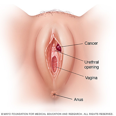 Tratamiento del cáncer de vulva