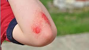 Hem vaig caure en patinet i hem vaig obrir el colze