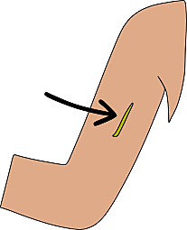 IMPLANTE ANTICONCEPTIVO