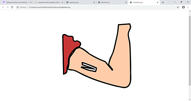 implante anticonceptivo