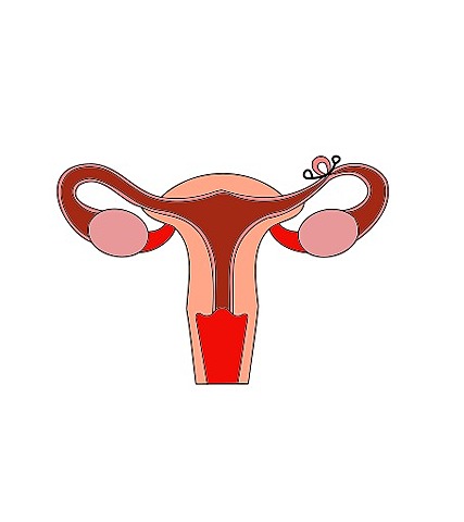 Ligadura de trompas de falopio