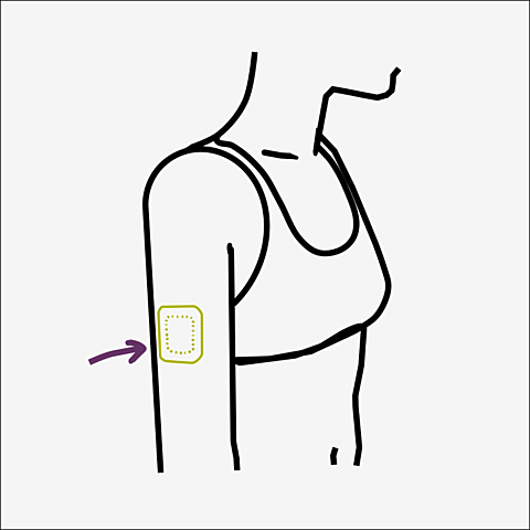 parche anticonceptivo