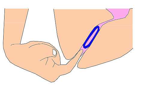 Anillo vaginal