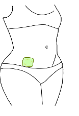 Parche Anticonceptivo