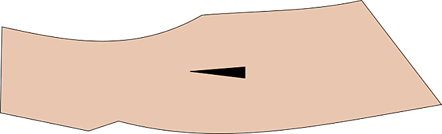 Implante Subdérmico de 5 años