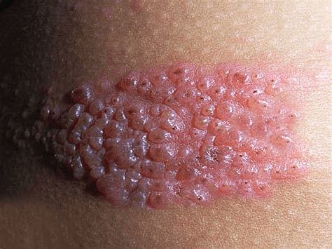 Artículo sobre cuadro clínico de la desnutrición en el sureste de México