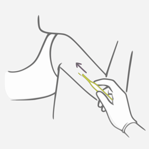 Implante Anticonceptivo