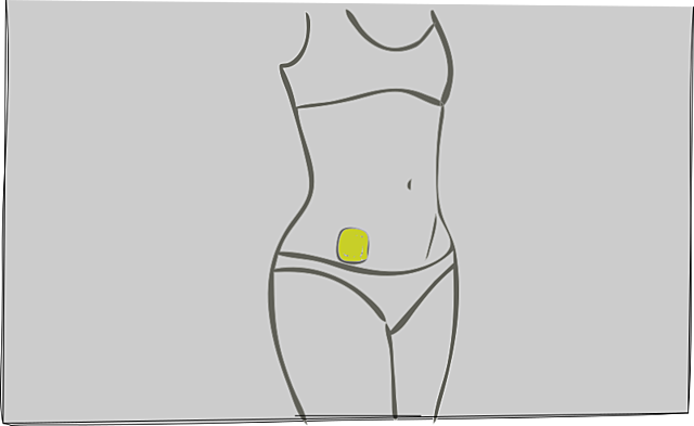 parche anticonceptivo