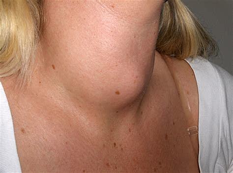 La INCAP sustituye el iodato potásico para combatir el bocio endémico