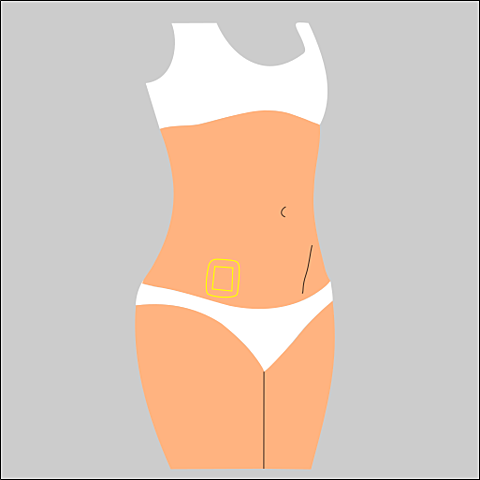 PARCHE ANTICONCEPTIVO