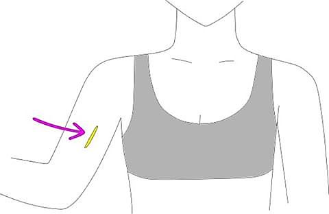 Implante Anticonceptivo