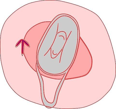 Esponja Anticonceptiva