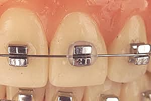 Aleaciones de la ortodoncia