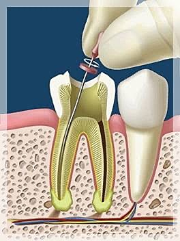 Especialidad de Endodoncia