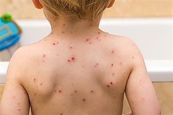 CHICKEN POX DISEASE