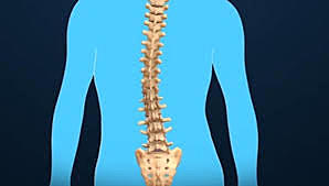 SCOLIOSIS
