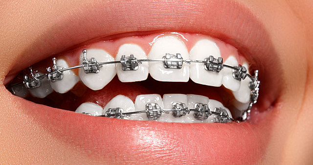 First photograph with braces