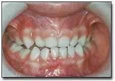 OVERJET BORDE A BORDE( 5 AÑOS)