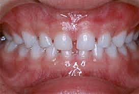 OVERJET 4mm (2 AÑOS)