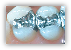 LOS MATERIALES DE RESTAURACIÓN (EUA)