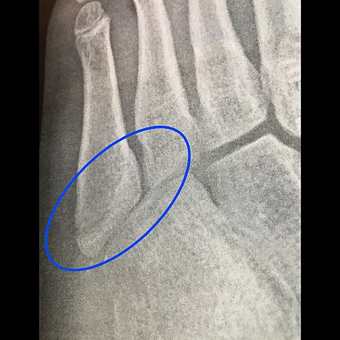 Amelia’s First Broken Bone (11)