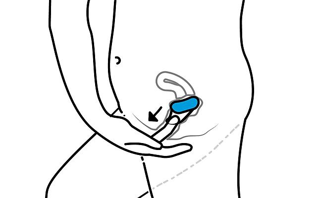 la esponja anticonseptiva