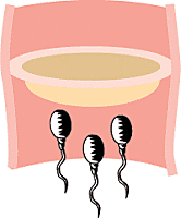 diafragma anticonseptivo