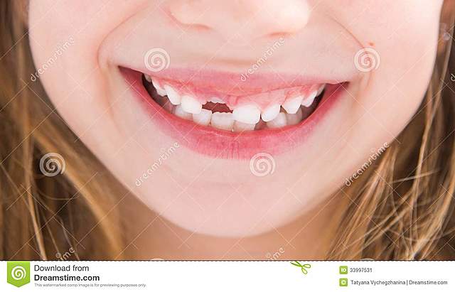SE ME CALLERON LOS DIENTES