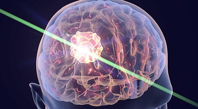 TRATAMIENTO LASER CONTRA EL ALZHEIMER