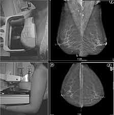 Gershon – Cohen y Strickler