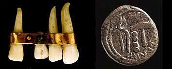 Prótesis fija etrusca