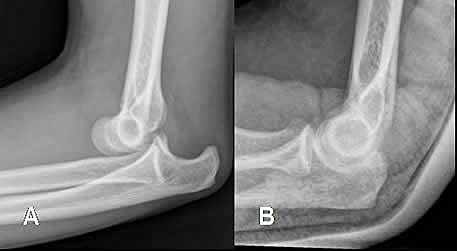 Mi Codo Dislocado :0