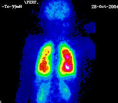 rayos gamma (Frederic Joliot e Irene Curie)