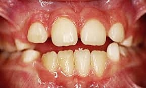 Denticion Mixta 6-12 años