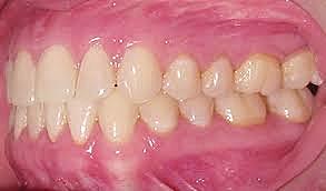 Dentición Permanente- Llaves de Andrews