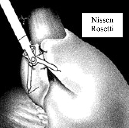 Resección del cardias vía toracoabdominal
