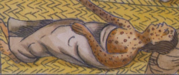 Small Pox Begins Spreading to the Native Americans