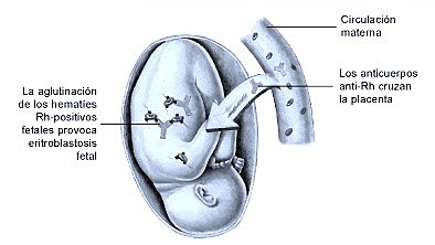 Causa de eritroblastosis fetal