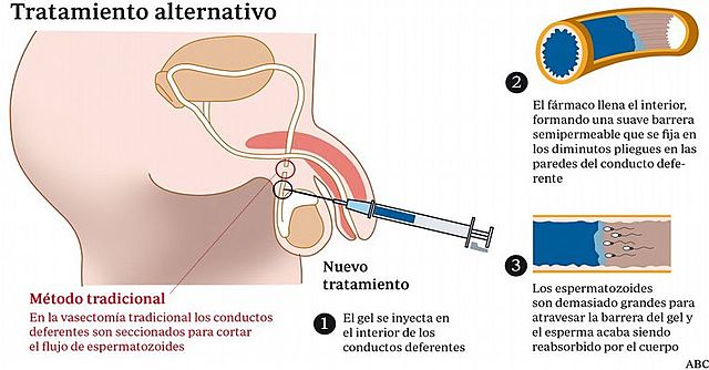 Inyección anticonceptiva para hombres