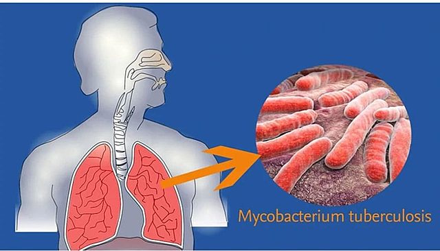 Robert Koch halló el bacilo causante de la tuberculosis.