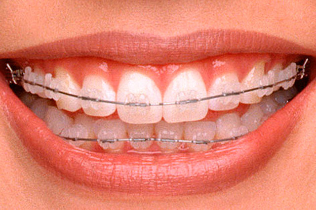 sustitución por tratamientos de ortodoncia transparentes