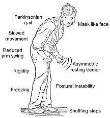 síndrome de Parkinson (Parkinson)