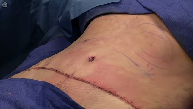 Primera Cirugía Abdominal