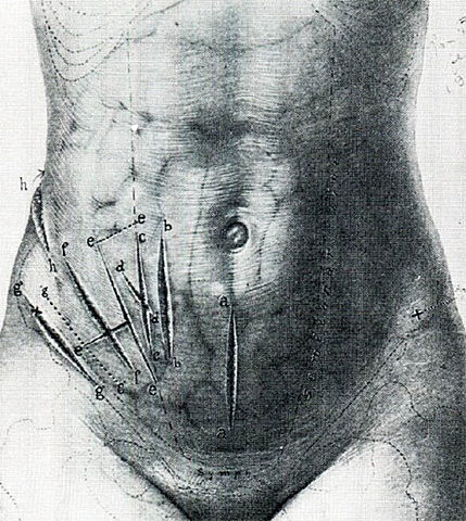 Dr. Henry Hancock drenó un absceso abdominal.