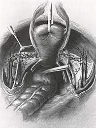 Emil Ries - Primera histerectomía extendida.