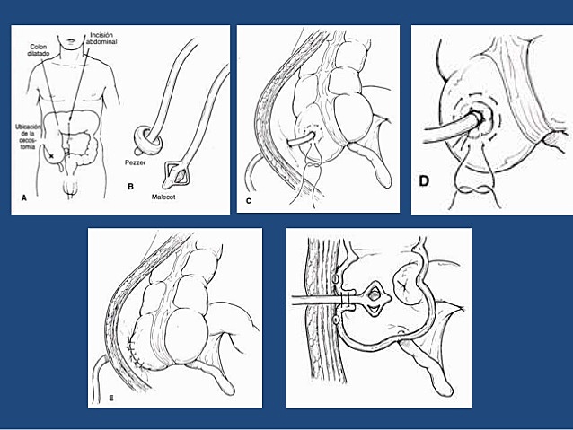 Wangensteen - Demostró los efectos benéficos de la descompresión intestinal.