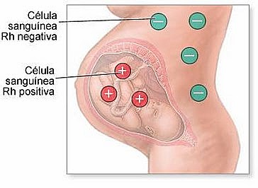 Eritroblastosis Fetal.