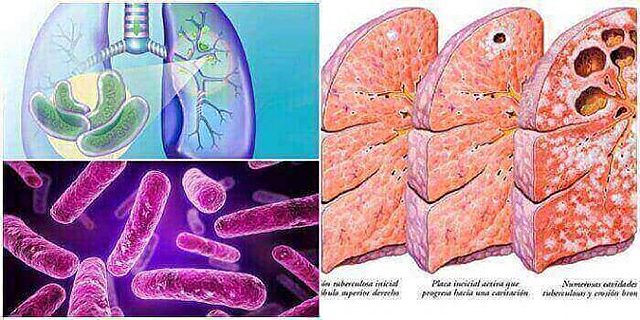Descubrimiento de la tuberculosis.