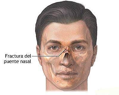 Fractura de nariz