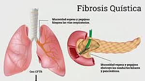 Fibrosis Quística
